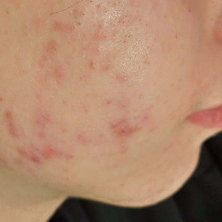 Risultati Mavex Sebo Balance anti-acne