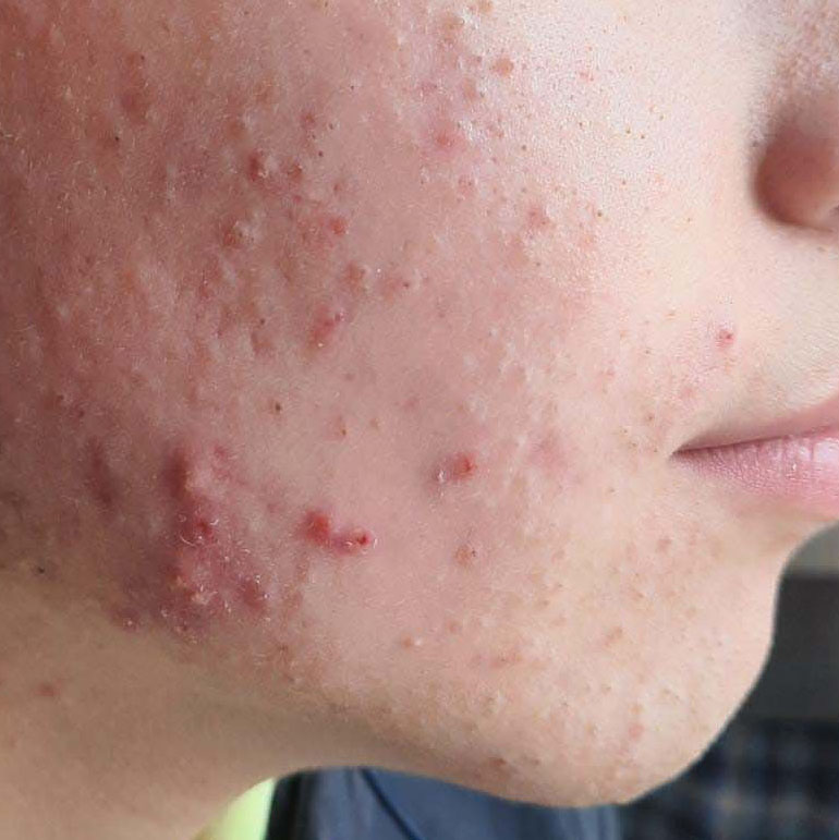 Risultati Mavex Sebo Balance anti-acne